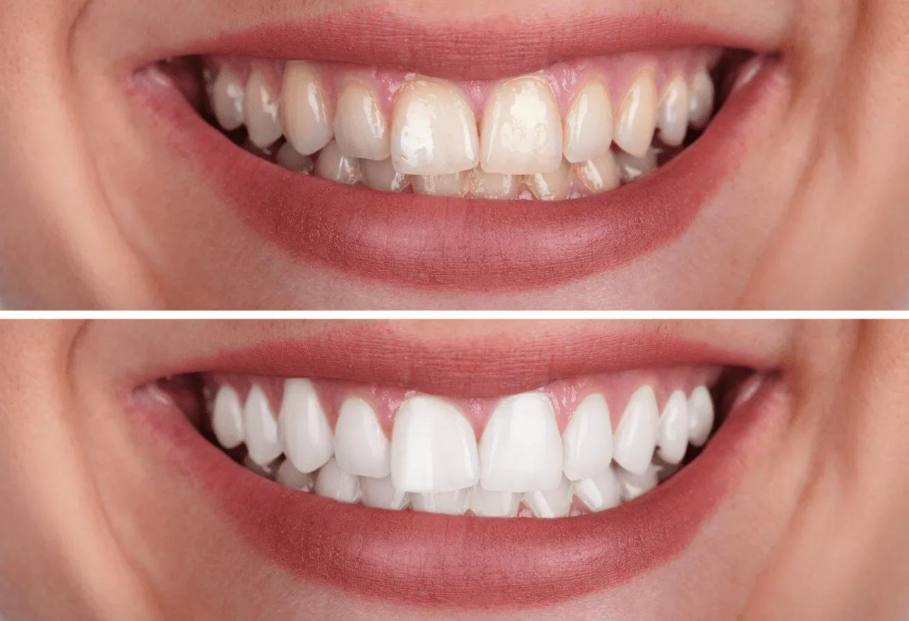 Professional teeth whitening treatment